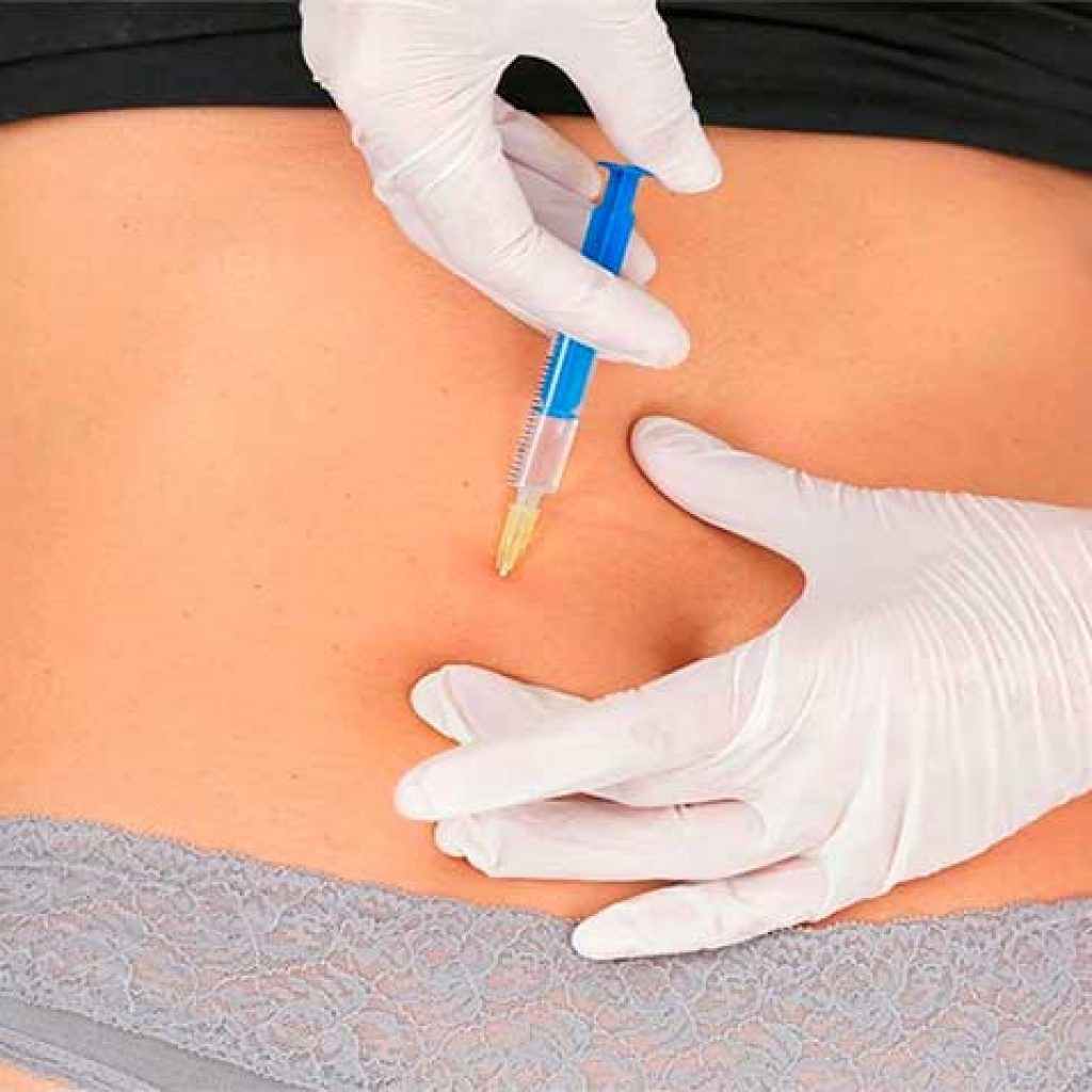 La carboxiterapia es una técnica que consiste en la aplicación de dióxido de carbono por vía subcutánea, causando que los vasos capilares y vías sanguíneas se dilaten...