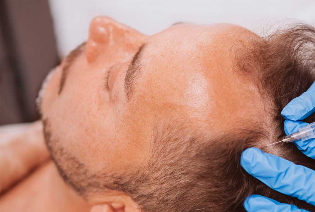 plasma-rico-en-plaquetas-para-la-alopecia-lifeskin